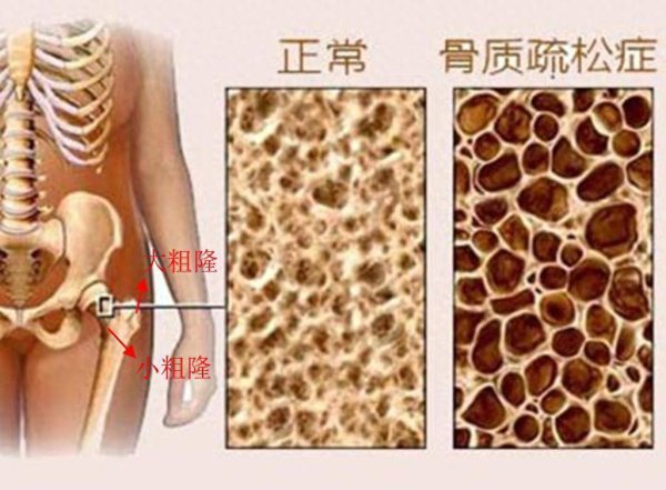 鼎合网配资 “寂静杀手”—骨质疏松症